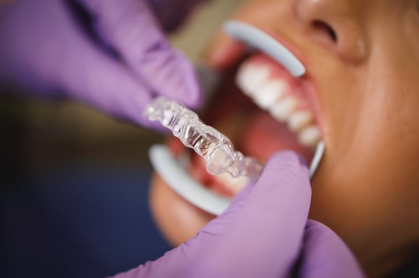 Invisalign à Marcq en Baroeul : un sourire discret et réussi